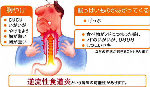 逆流性食道炎の症状